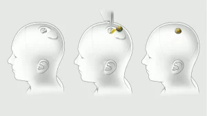植入晶片｜馬斯克Neuralink首測試 將晶片植入患者腦部 四肢癱瘓靠「念力」打機捉棋
